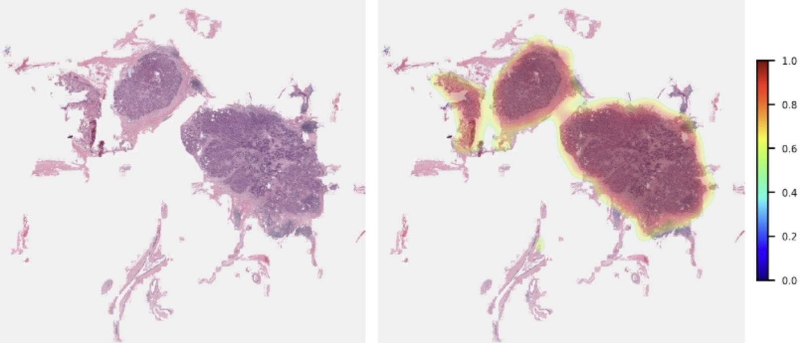 Breast Cancer Detection